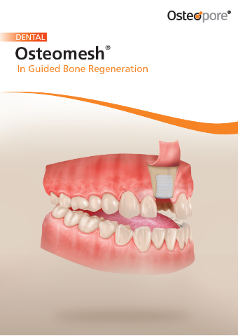 Guided bone regeneration brochure
