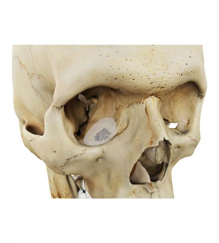 Orbital Floor Reconstruction Osteopore