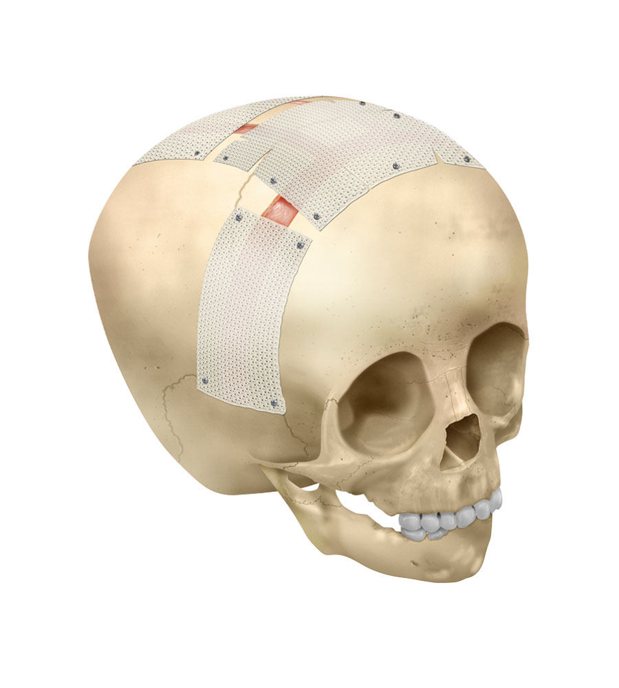 Craniosynostosis