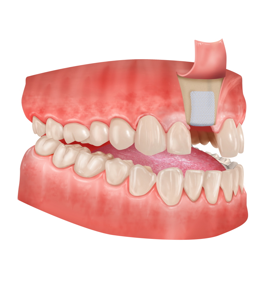 Guided Bone Regeneration