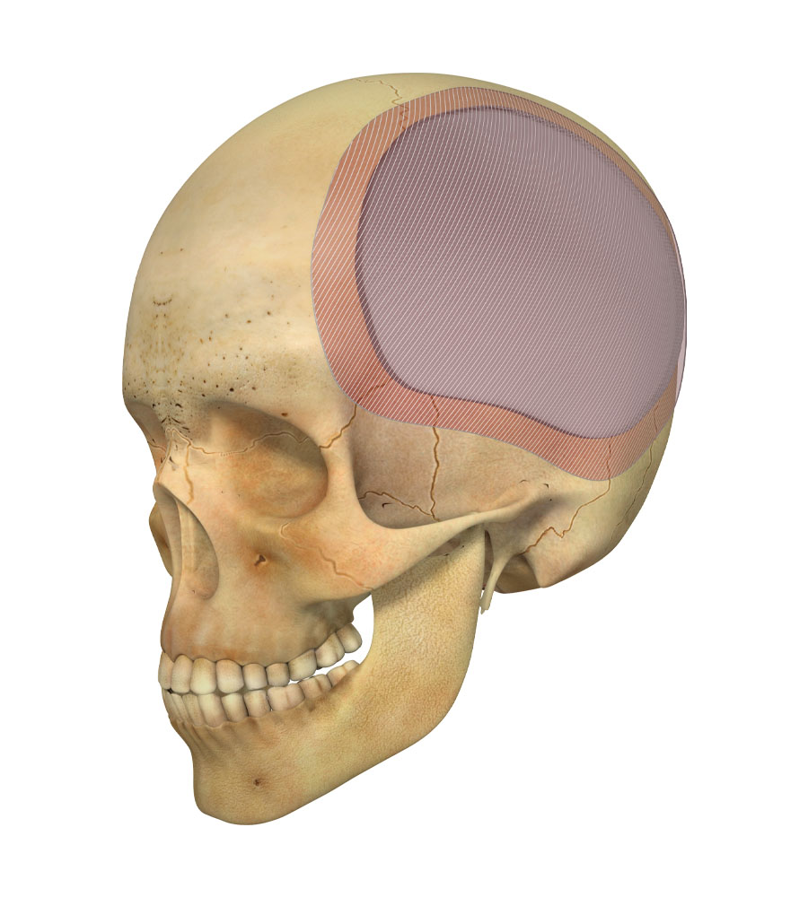 Cranioplasty PSI