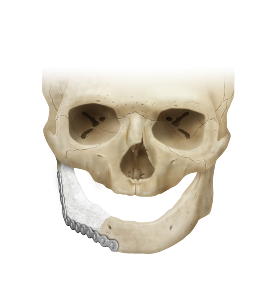 Mandible PSI