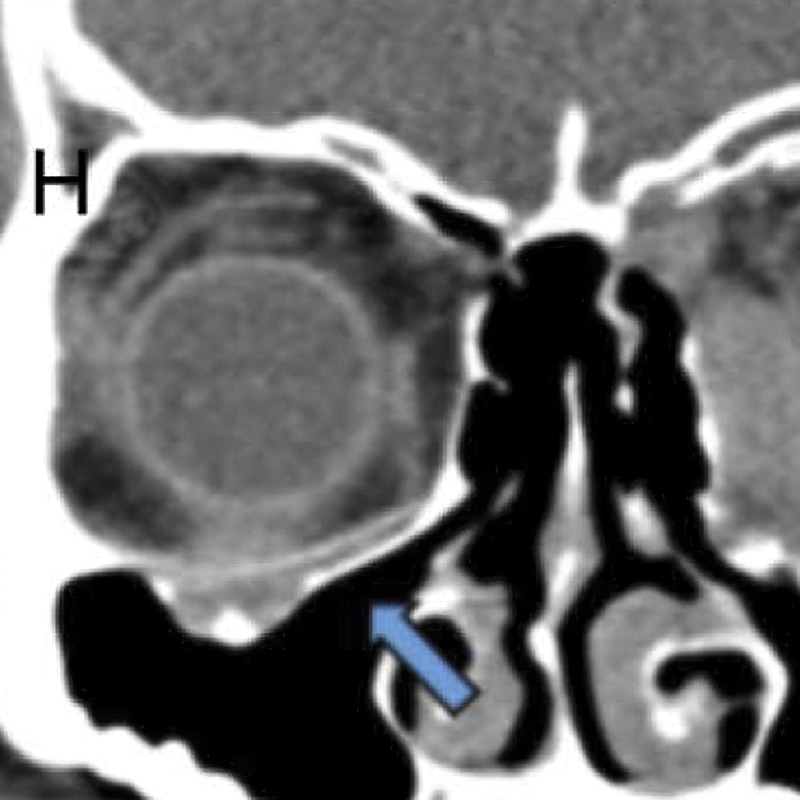 2006 - Clinical Trial Osteomesh