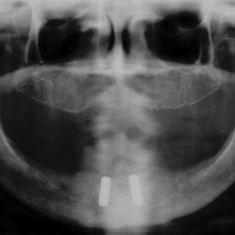 2007 - First-in-human 3D printed patient specific implant with PCL-TCP microarchitecture