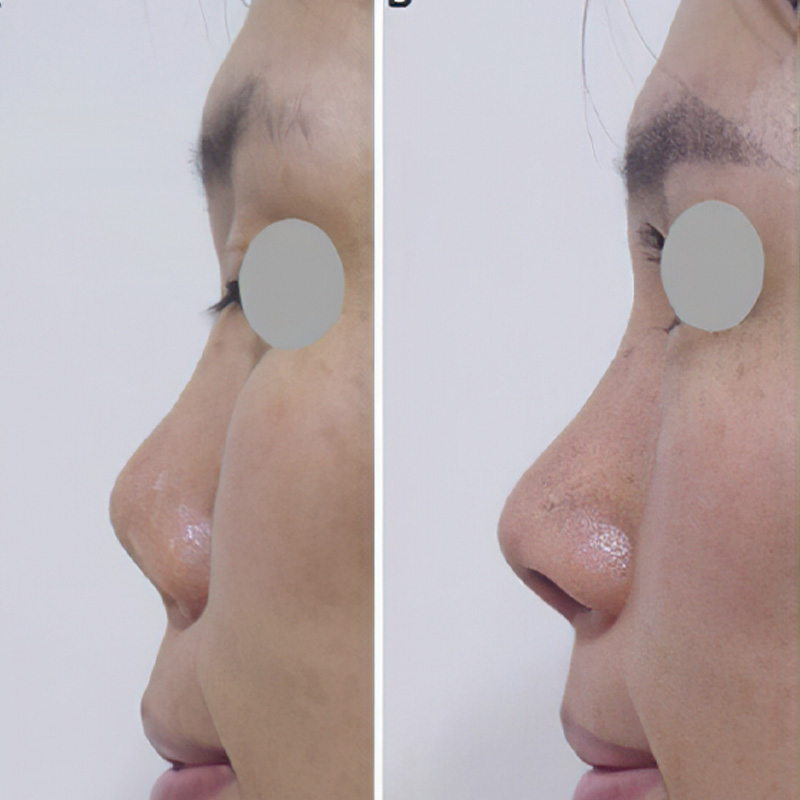 2017 - First-in-human rhinoplasty with Osteomesh