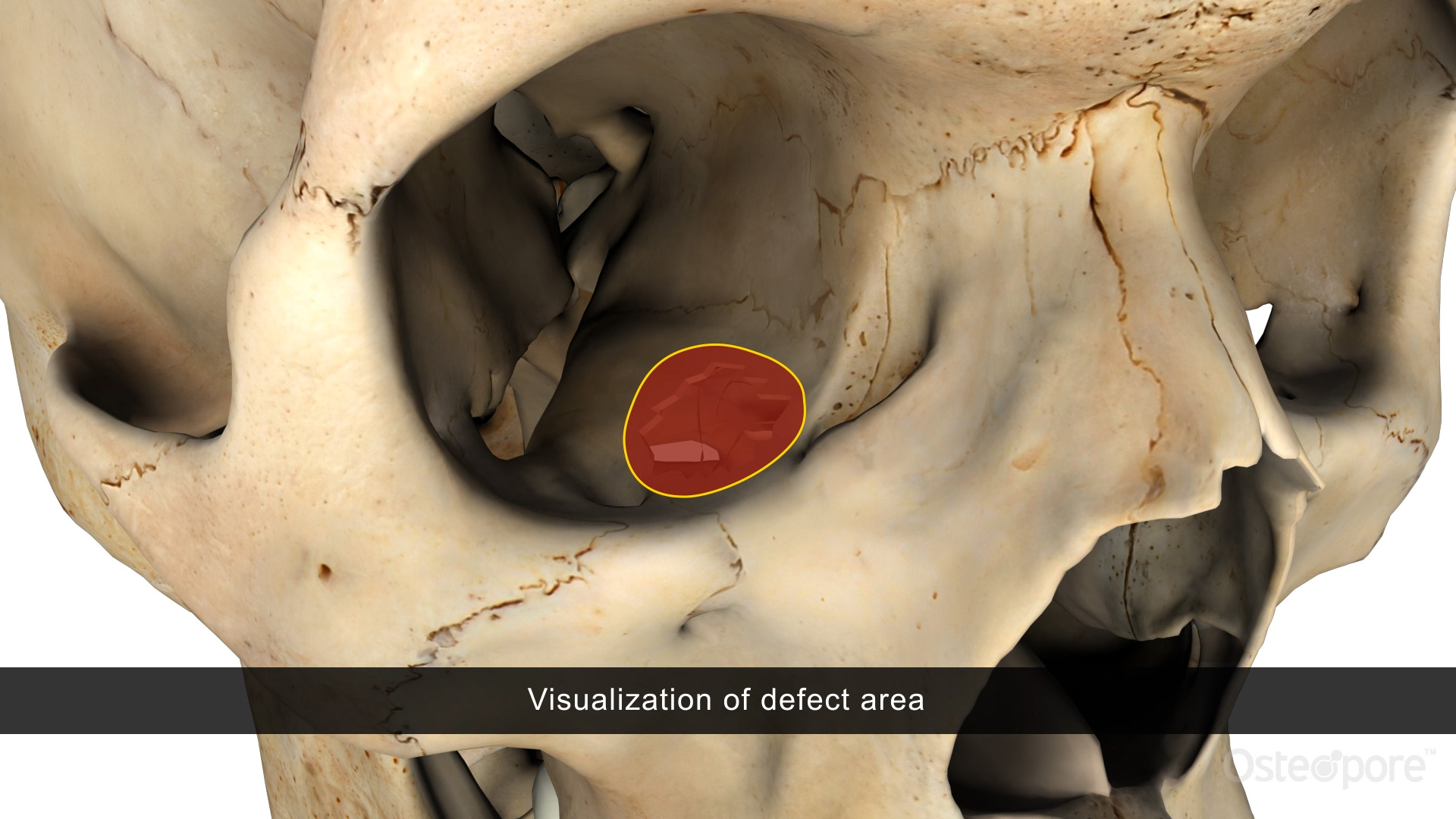 Orbital Floor Reconstruction Osteopore